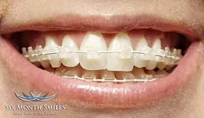 six month smiles