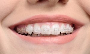 Benefits of Six Month Smiles
