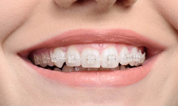 How do orthodontists bond braces to teeth? « Smiles by White