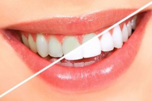 teeth whitening