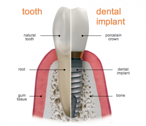 dental implant