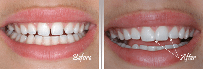 Dental help - Tandblekning - Before / After