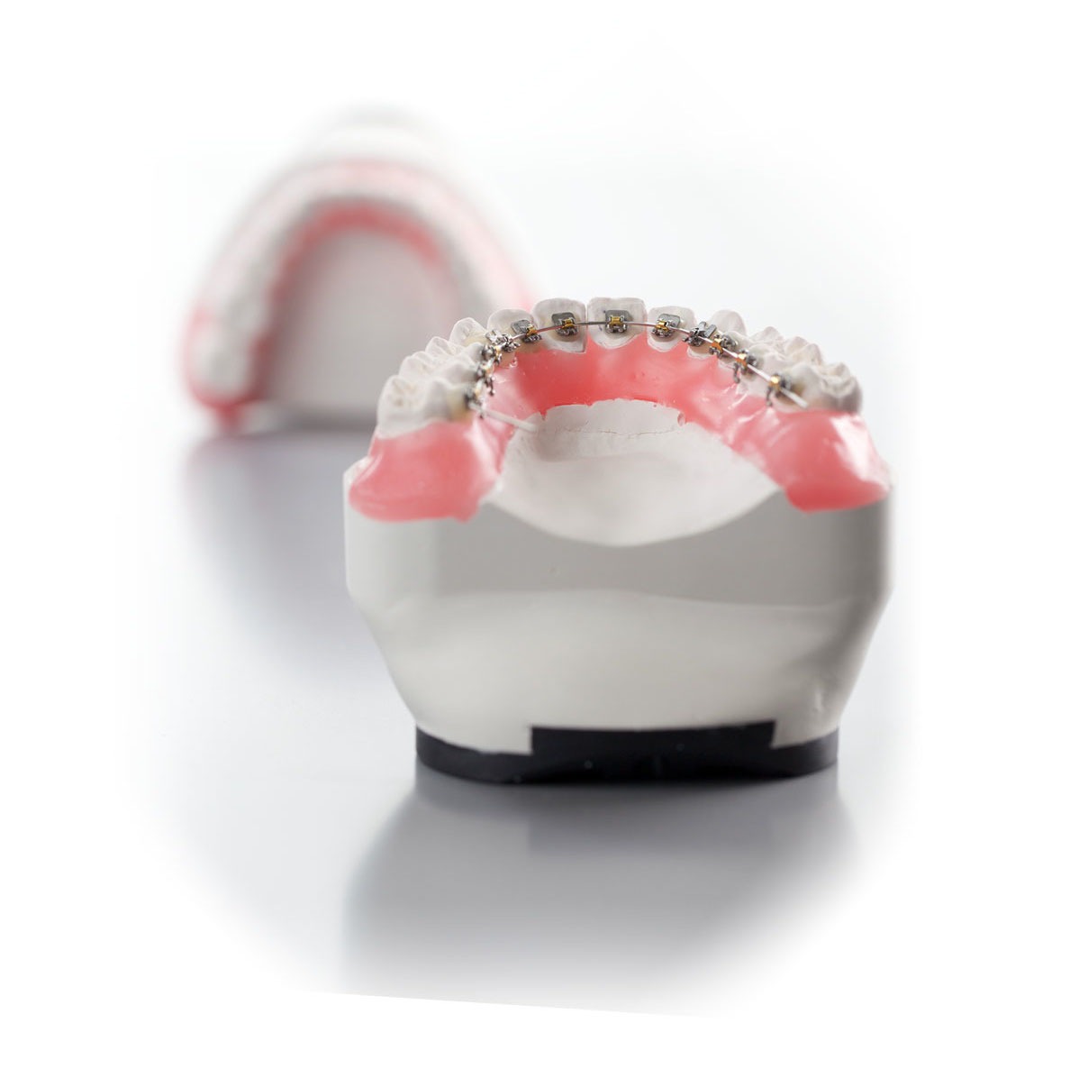 What Are Lingual Braces?