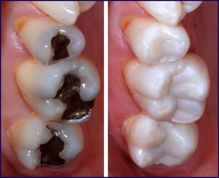 White Filings V Silver Fillings at Birchgrove Dental