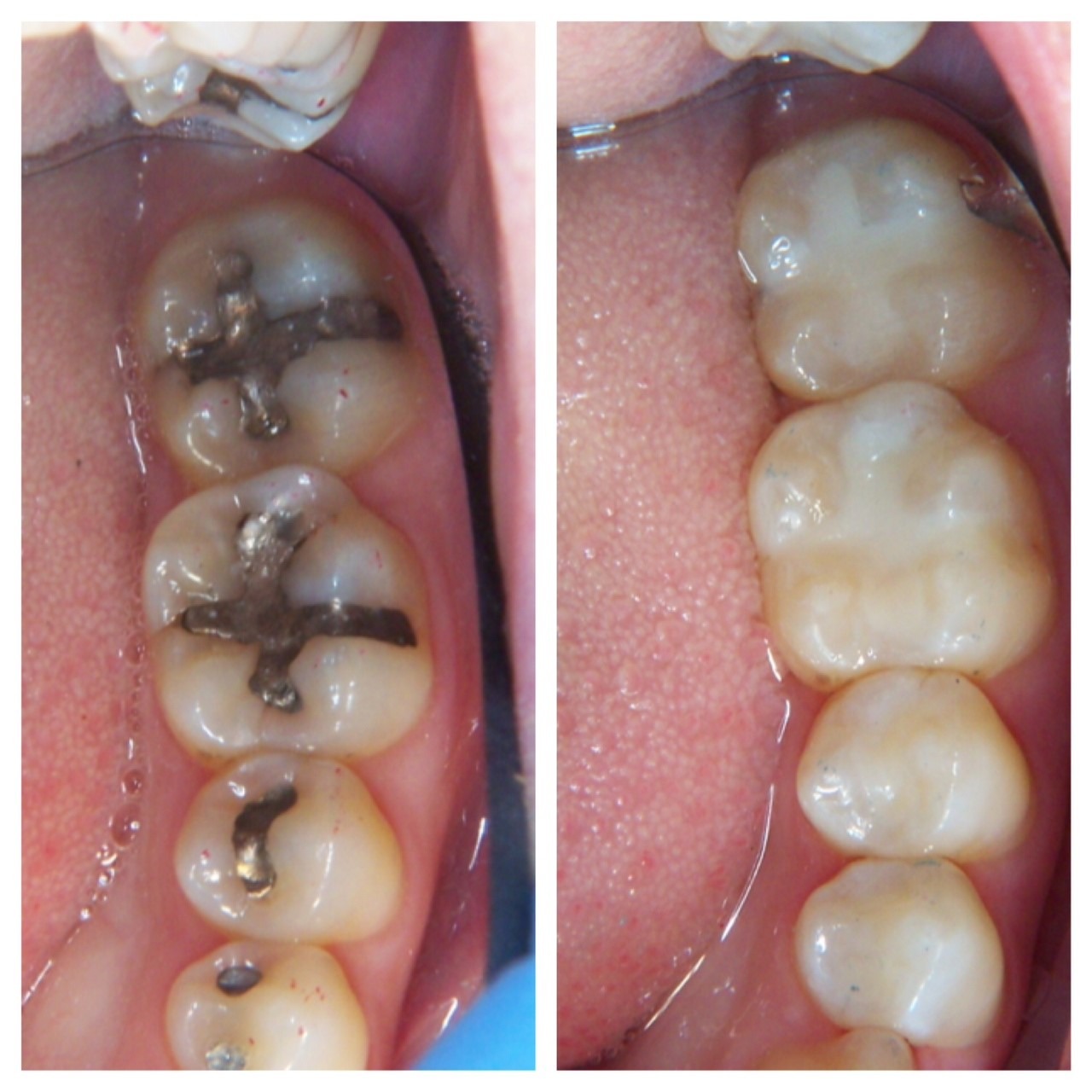 White Filings V Silver Fillings at Birchgrove Dental