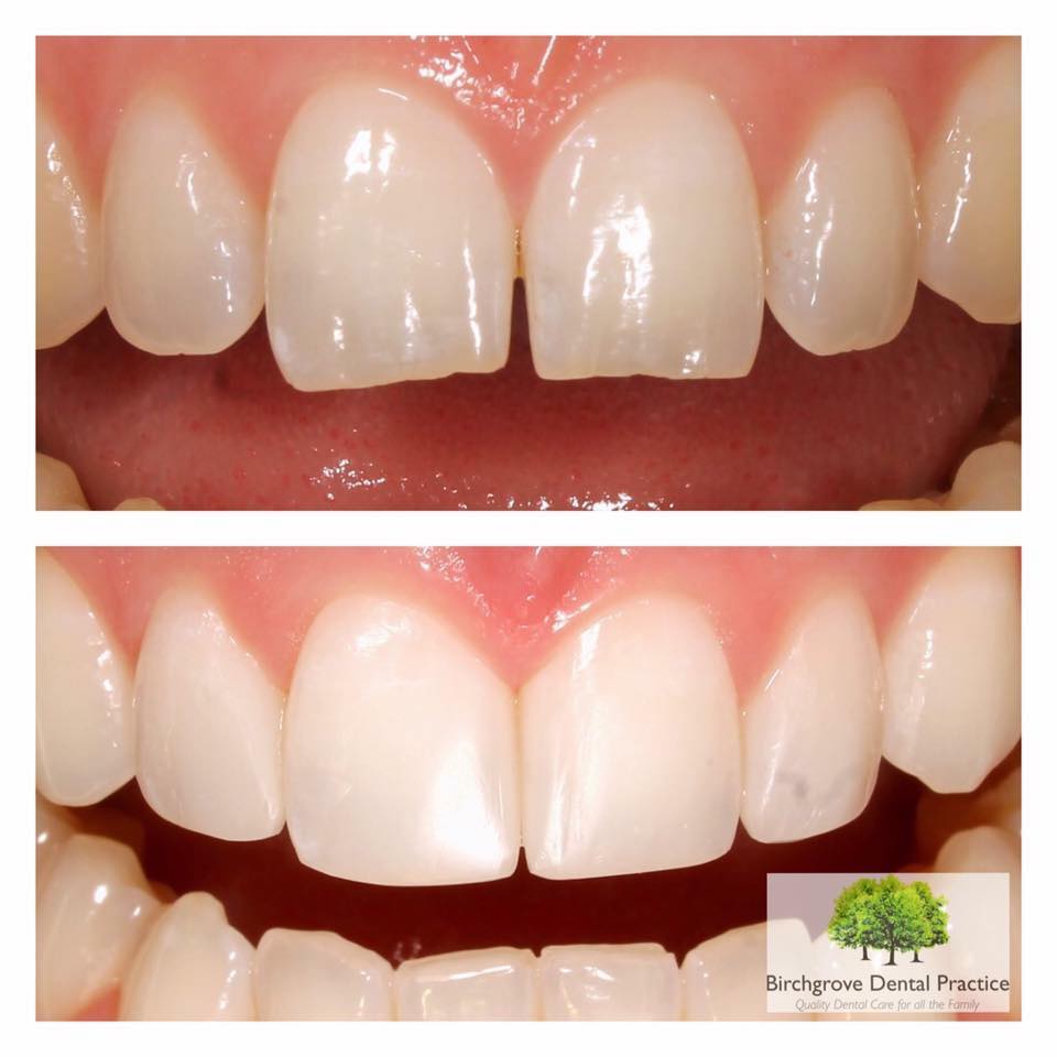 What Is Composite Bonding Birchgrove Dental