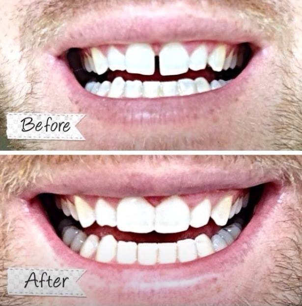 composite bonding before and after 2
