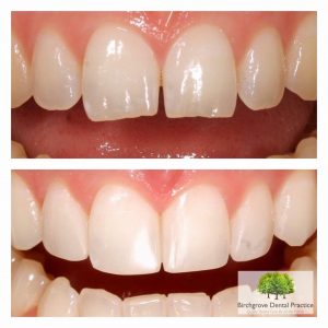 Does Composite Bonding Damage Teeth?