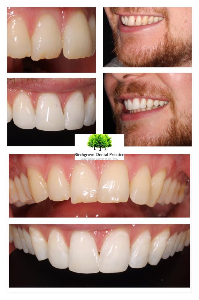 Ice braces online