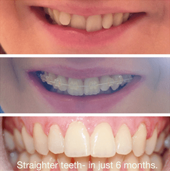 six month smiles cost uk