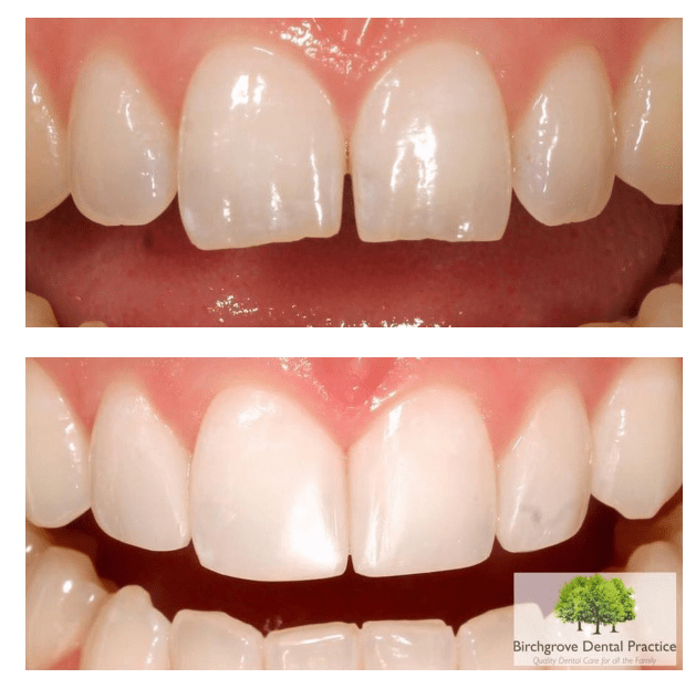 Tooth Enamel Repair Kit Uk - TeethWalls