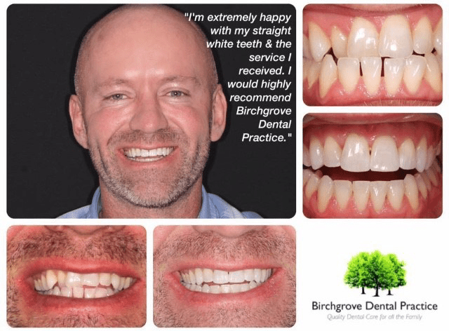 teeth straightening cardiff