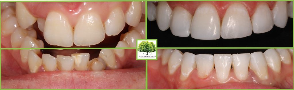 Cosmetic Bonding Cardiff - Composite Bonding | Birchgrove ...