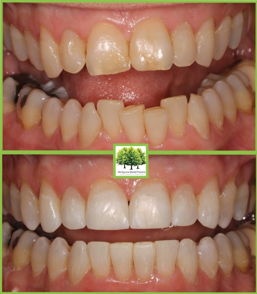 Orthodontics Cardiff Birchgrove Dental