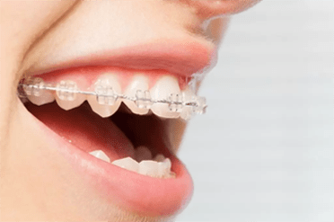 white-braces white braces
