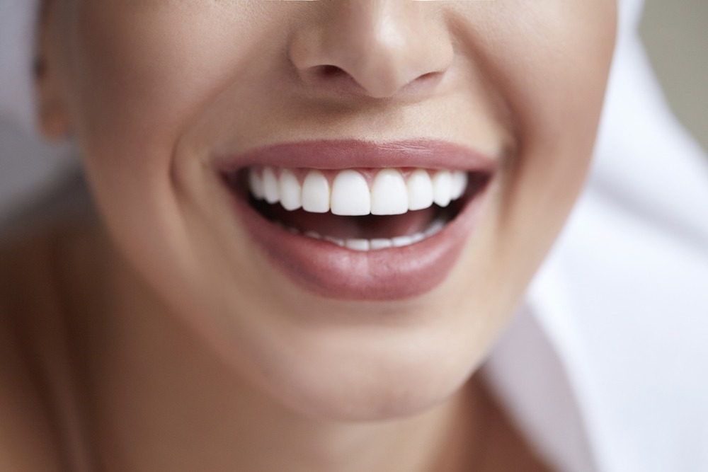 dental veneers cardiff