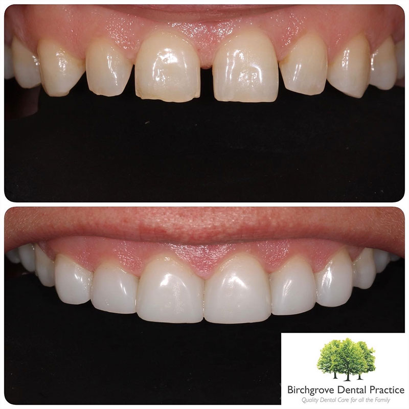 smile makeover in cardiff