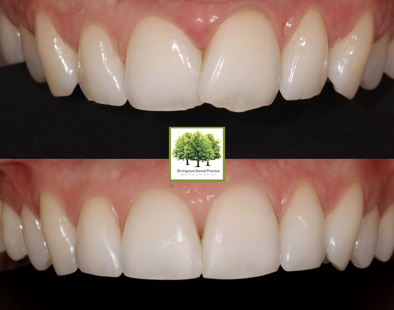 smile makeover cardiff