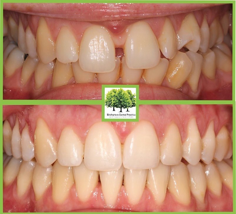 fixed metal braces in Cardiff