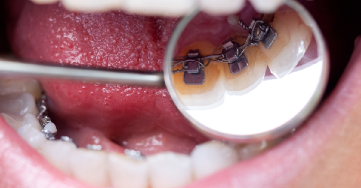 can lingual braces for an overbite