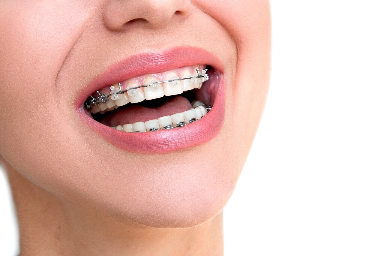 damon clear braces