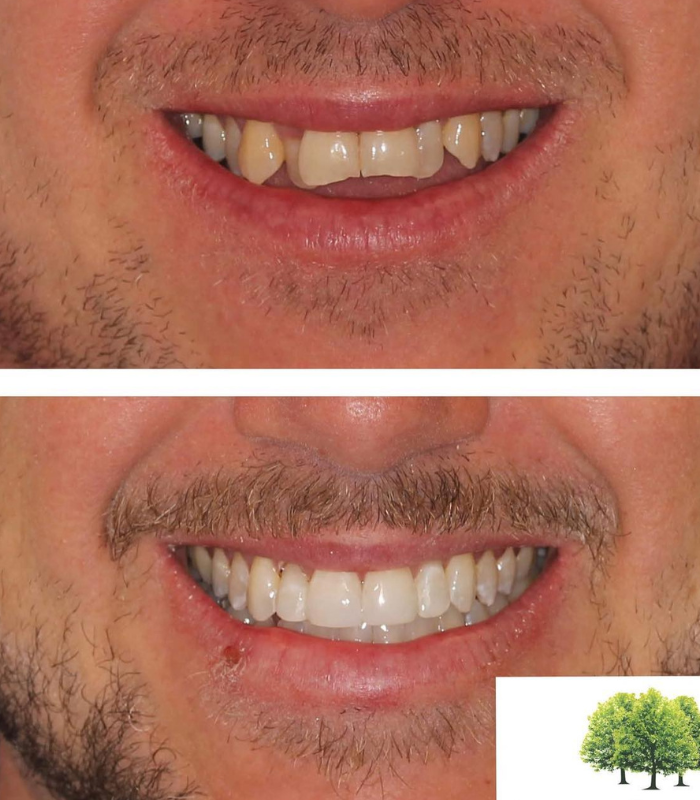 fixed braces