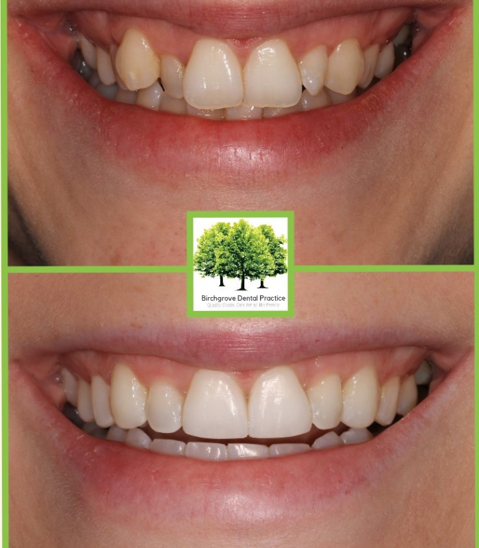 Orthodontics Cardiff Braces & Aligners Birchgrove Dental