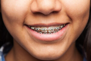 How Often Should You Change Rubber Bands on Braces?