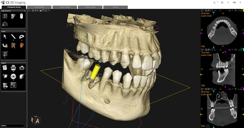 teeth implants cardiff