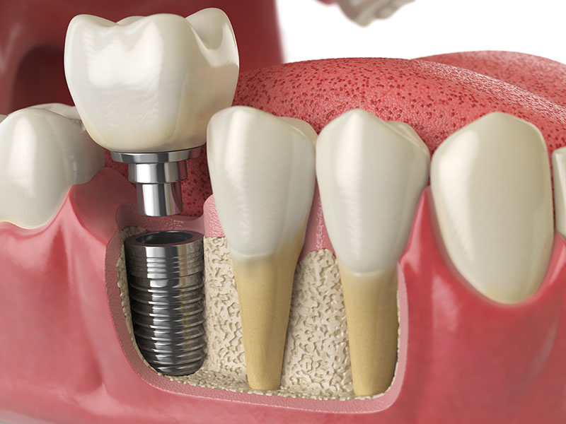 dental implants cardiff dental implants cardiff