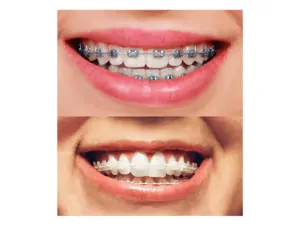 Are Metal Braces Faster Than Ceramic?