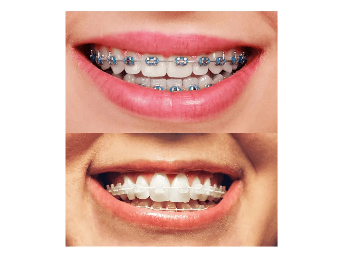 metal versus ceramic brace comparison.
