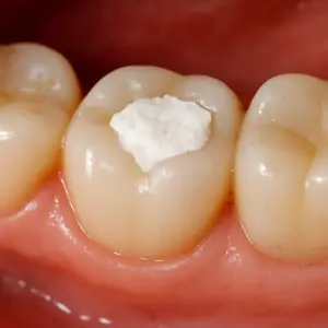 How Long Can a Temporary Filling Last and What Affects Its Lifespan?