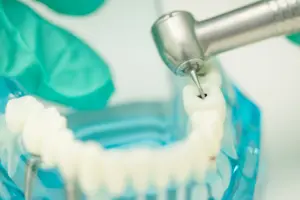 How Tooth Fillings Are Done?