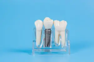 Types of Dental Implants Explained