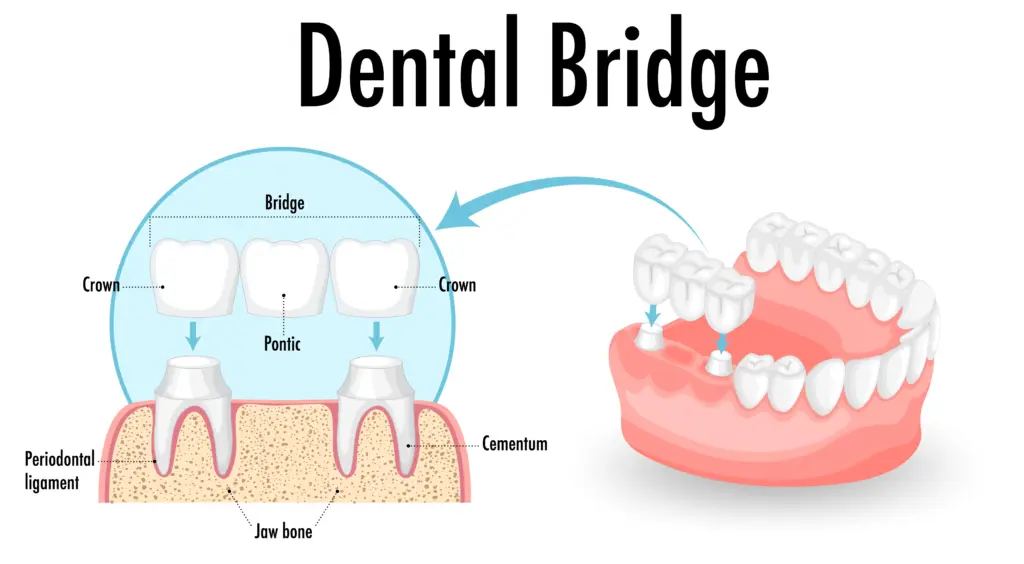 Dental bridge illustration showing crowns and pontic used to replace missing teeth.