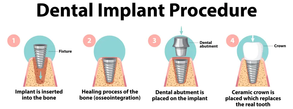 Step by step guide to the molar tooth implant process with crown placement.