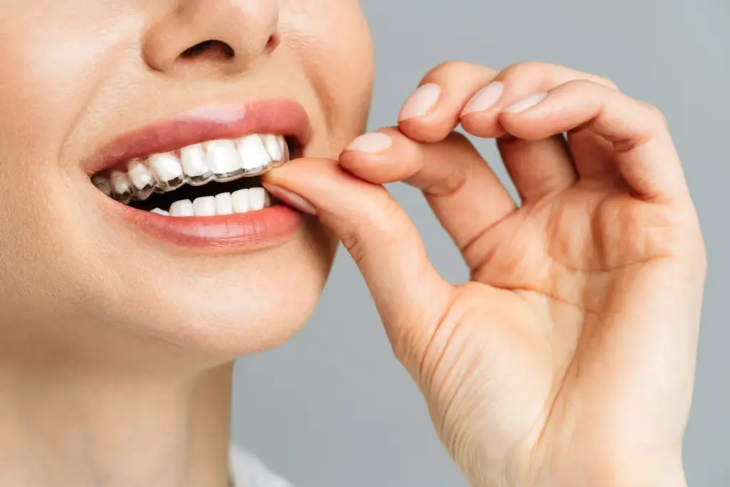 Clear aligner fitted after teeth shaving created space for predictable tooth movement.