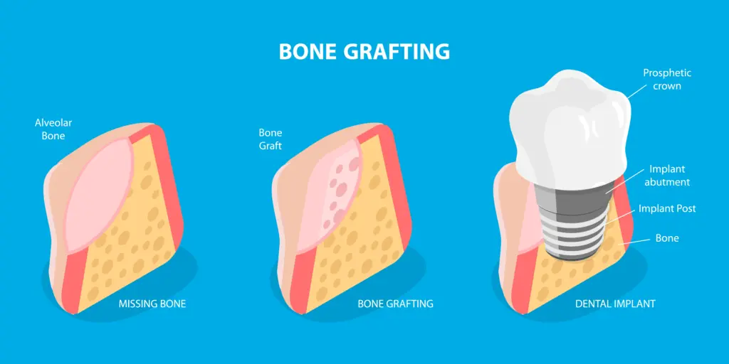 Simple diagram showing how a dental bone graft supports the jaw before an implant is placed.