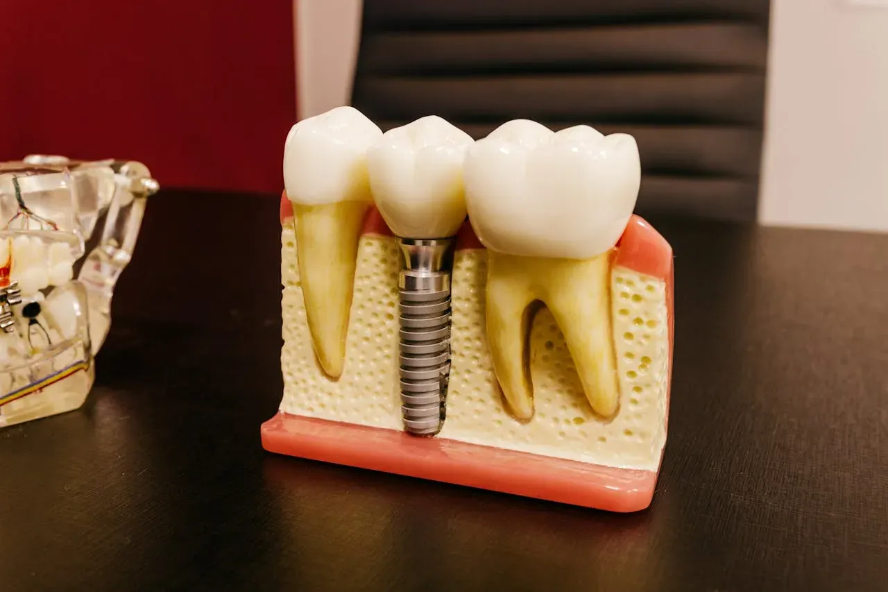 Implant and jaw model used to explain what a dental bone graft does for implant support.