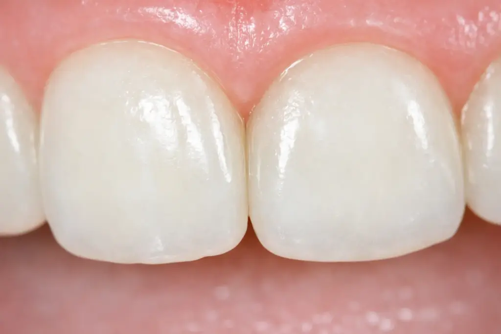 Close-up of two teeth touching to show areas a toothbrush cannot reach between teeth.