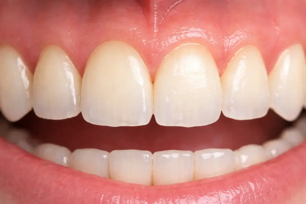 Early signs of tooth wear visible on the enamel edges of front teeth.
