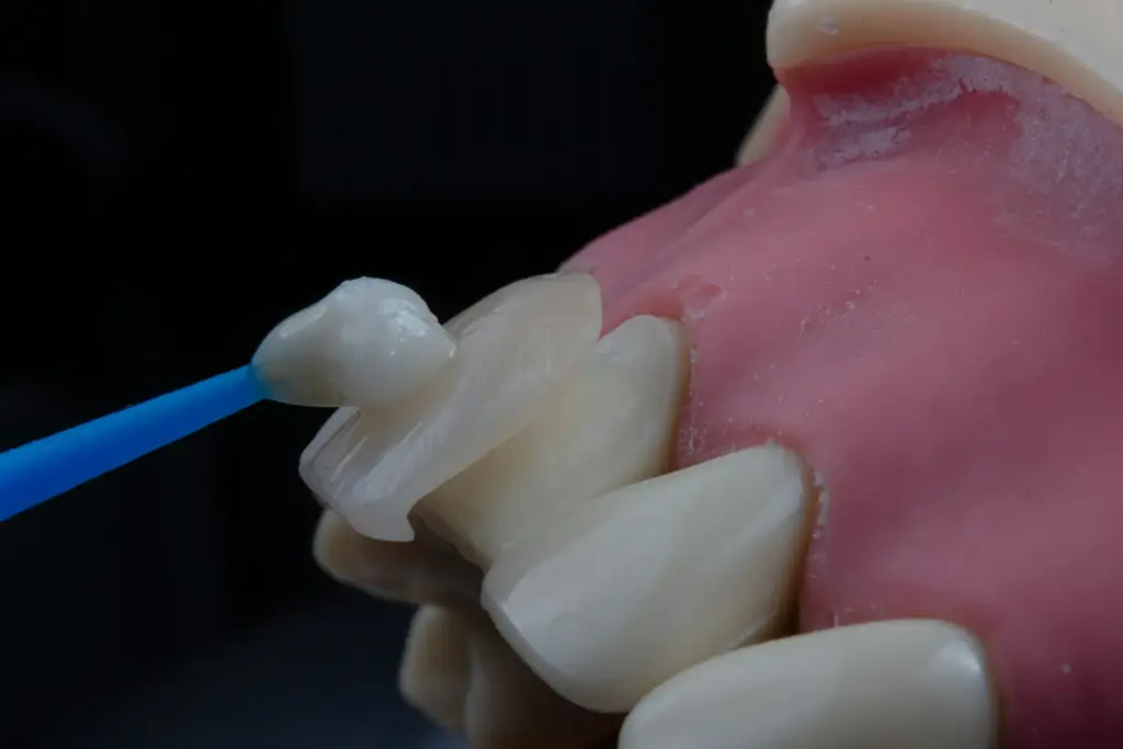 Close-up of a translucent porcelain dental veneer being positioned onto a tooth model, showing the thin ceramic shell used in cosmetic dentistry.