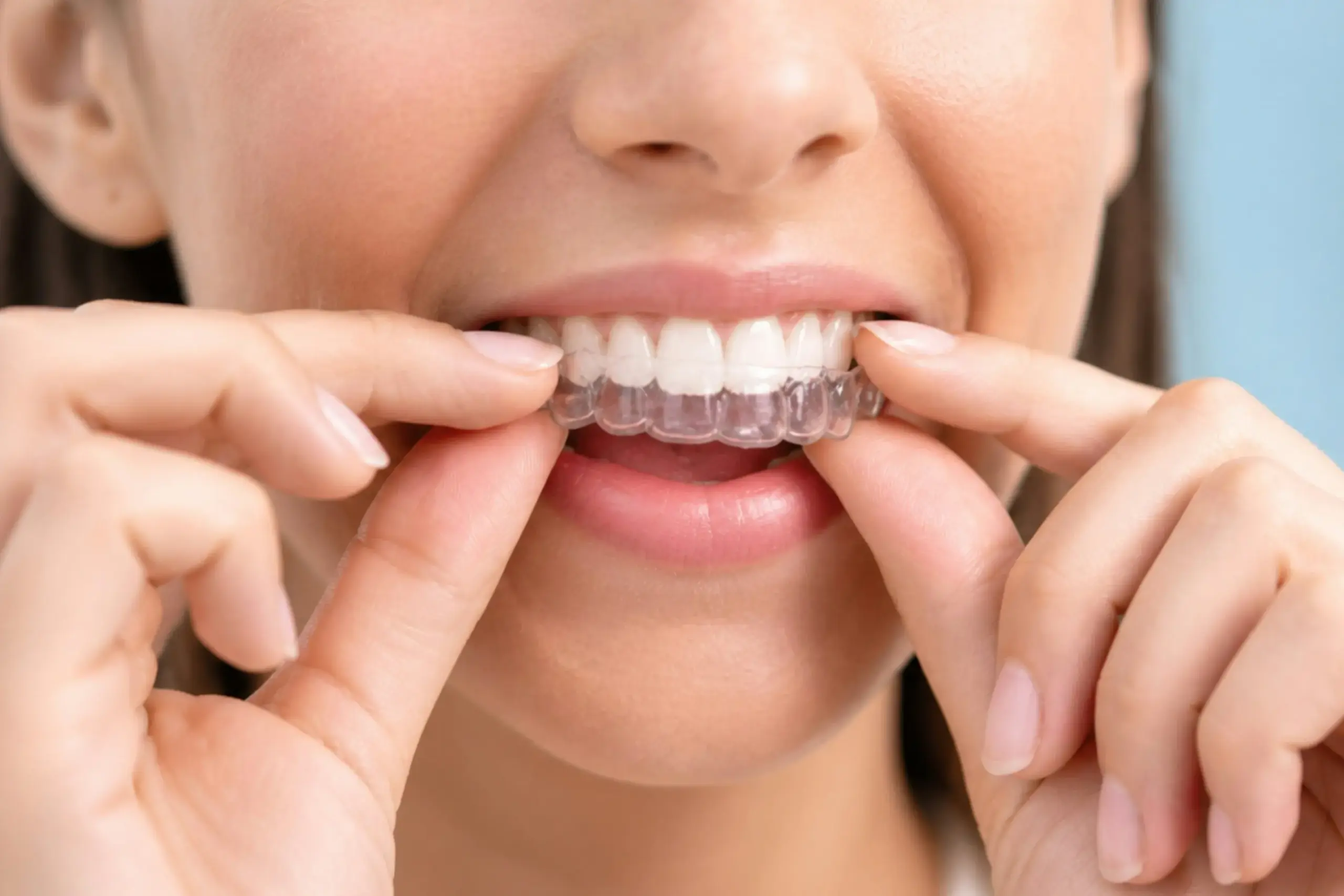 Patient fitting a clear aligner over teeth during Invisalign treatment.