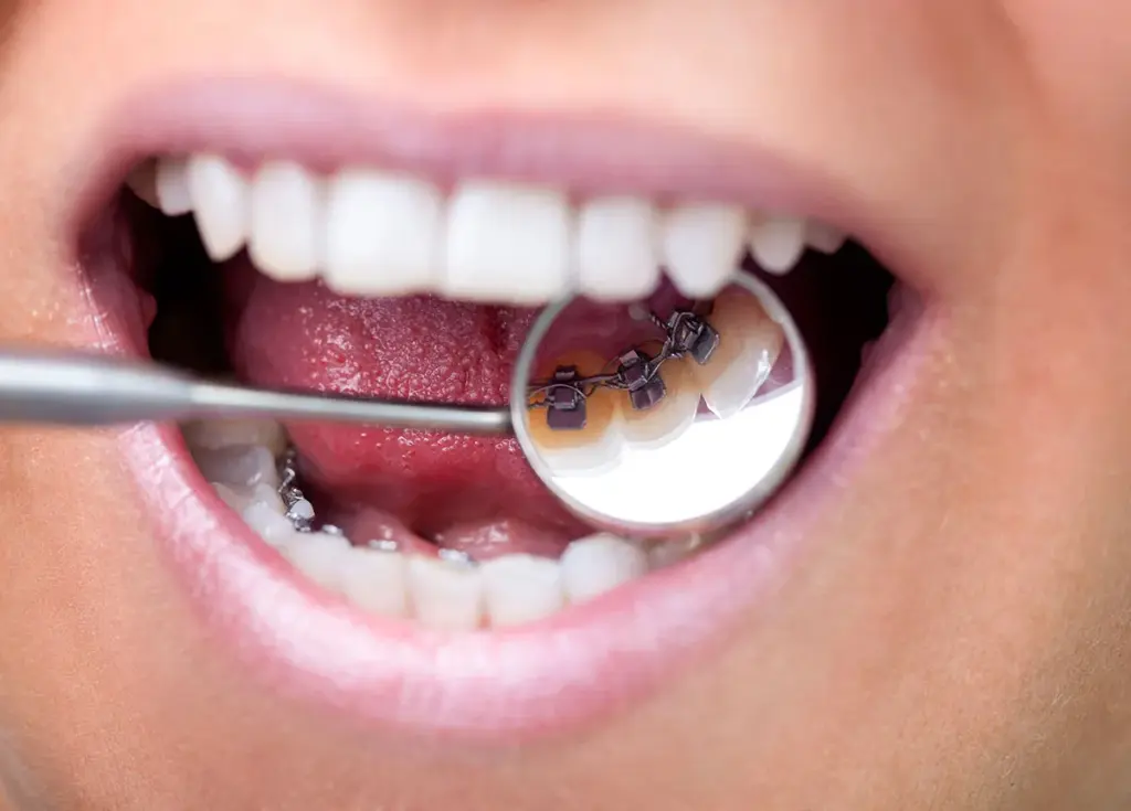 Lingual braces fitted behind the teeth during orthodontic treatment.