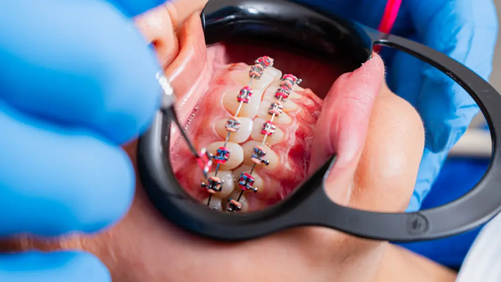 Dental professional checking fixed metal braces during orthodontic treatment.