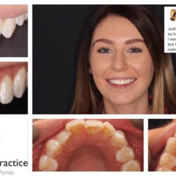 braces 5