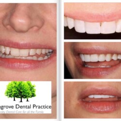 braces 6