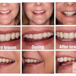 braces 12