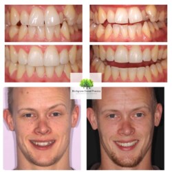 braces 8